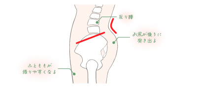 反り腰